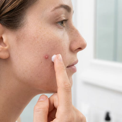 Acne Treatment Cream