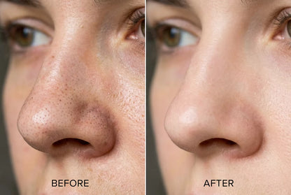 Blackhead removal strips